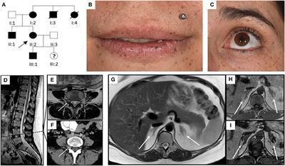 Obstetric and Neonatal Outcome of Pregnancy in Carney Complex: A Case Report